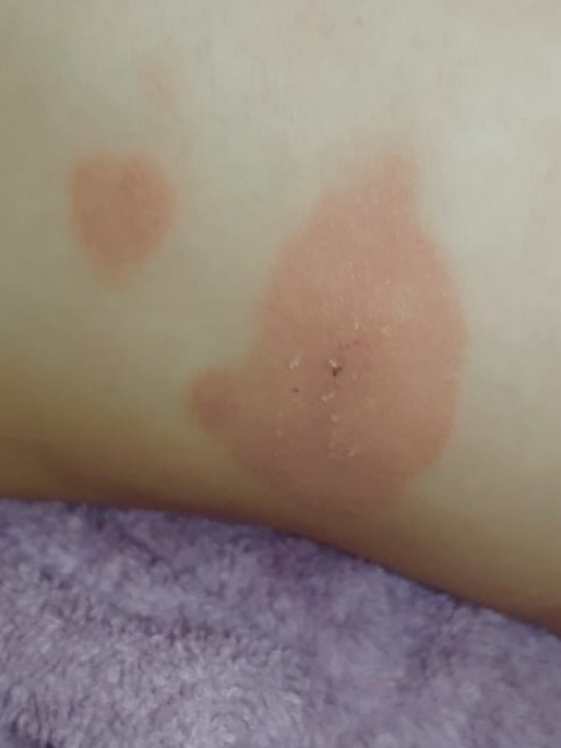 Atopijski dermatitis