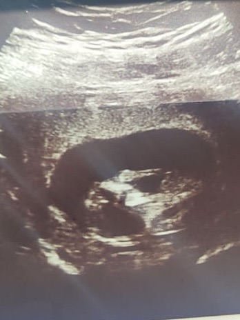 Placenta- drvo života